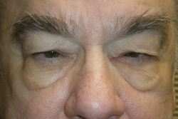 Combination Surgeries (eyelid lift and other)