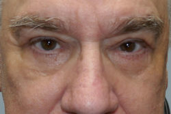 Combination Surgeries (eyelid lift and other)