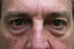 Combination Surgeries (eyelid lift and other)