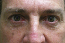 Combination Surgeries (eyelid lift and other)