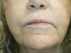 CO2 Laser Resurfacing (wrinkle/line reduction)