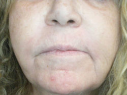 CO2 Laser Resurfacing (wrinkle/line reduction)