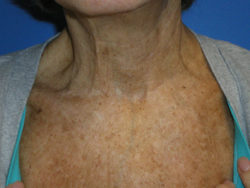 CO2 Laser Resurfacing (wrinkle/line reduction)