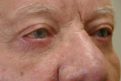 Combination Surgeries (eyelid lift and other)