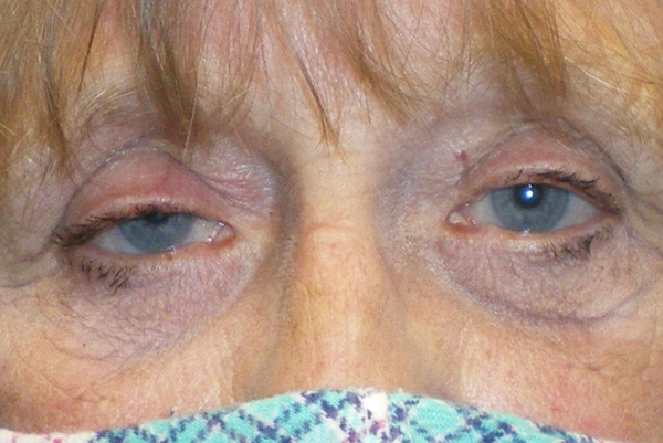 Eyelid Lift (blepharoplasty/ptosis repair)