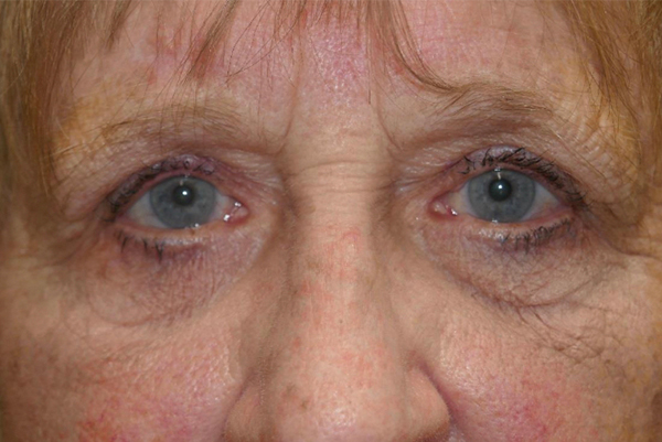 Eyelid Lift (blepharoplasty/ptosis repair)