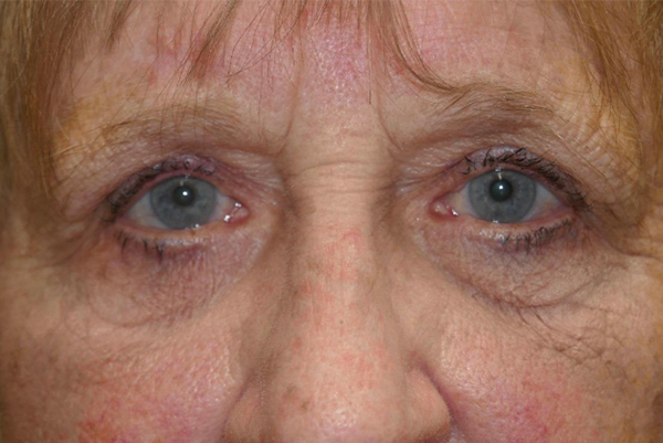 Ptosis Repair