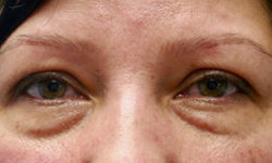 Lower Lid Blepharoplasty (lower eyelid eyelift)