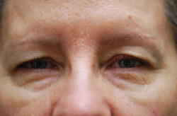 Upper/Lower Lid Blepharoplasty