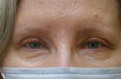 Upper/Lower Lid Blepharoplasty