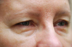 Upper/Lower Lid Blepharoplasty