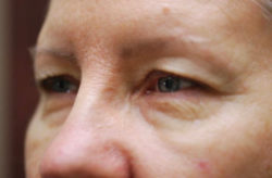 Upper/Lower Lid Blepharoplasty