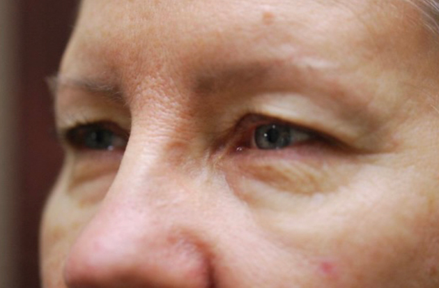 Upper/Lower Lid Blepharoplasty
