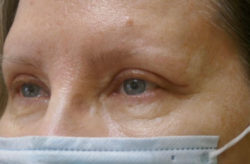 Upper/Lower Lid Blepharoplasty