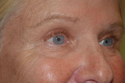 Lower Eyelid - External 2 Lower Eyelid Before and After Photo