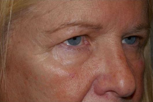 Lower Eyelid - External 1 Lower Eyelid Before and After Photo