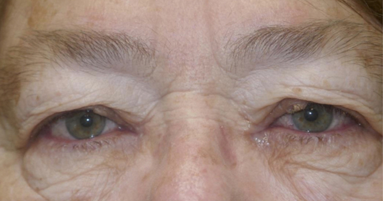 Upper Lid Blepharoplasty (upper eyelid lift)