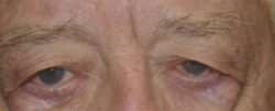 Upper Lid Blepharoplasty (upper eyelid lift)