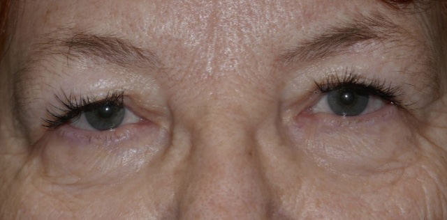 Upper Lid Blepharoplasty (upper eyelid lift)