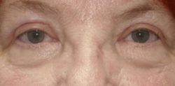 Upper Lid Blepharoplasty (upper eyelid lift)