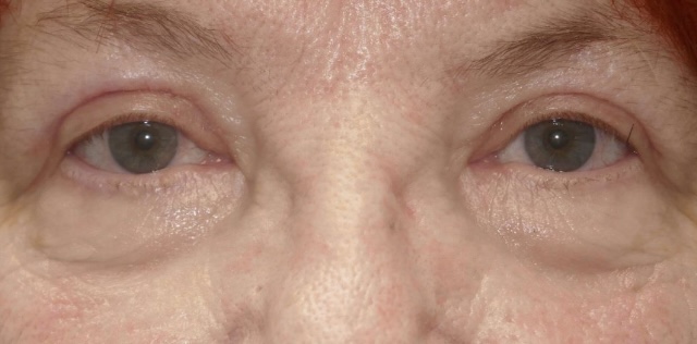 Upper Lid Blepharoplasty (upper eyelid lift)