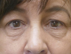 Combination Surgeries (eyelid lift and other)