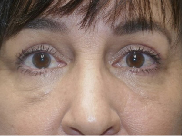 Upper/Lower Lid Blepharoplasty