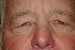 Eyelid Lift (blepharoplasty/ptosis repair)