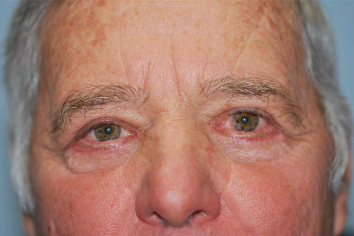 Eyelid Lift (blepharoplasty/ptosis repair)