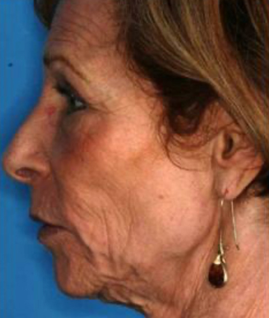 CO2 Laser Resurfacing (wrinkle/line reduction)