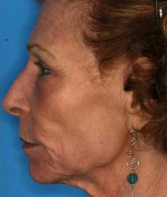 CO2 Laser Resurfacing (wrinkle/line reduction)