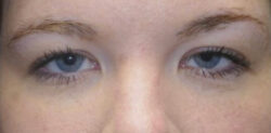 Upper Lid Blepharoplasty (upper eyelid lift)