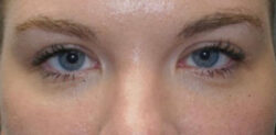 Upper Lid Blepharoplasty (upper eyelid lift)