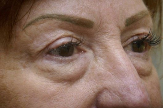 Lower Lid Blepharoplasty (lower eyelid eyelift)