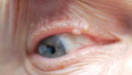 Lesion Removal