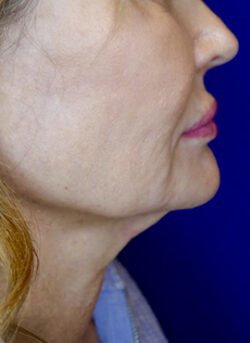 Face/Neck Lift