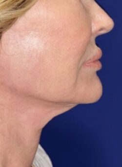 Face/Neck Lift