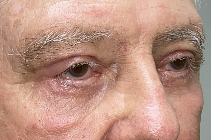 Upper/Lower Lid Blepharoplasty