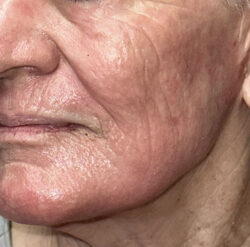 CO2 Laser Resurfacing (wrinkle/line reduction)