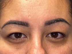 Upper Lid Blepharoplasty (upper eyelid lift)