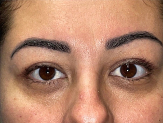 Upper Lid Blepharoplasty (upper eyelid lift)