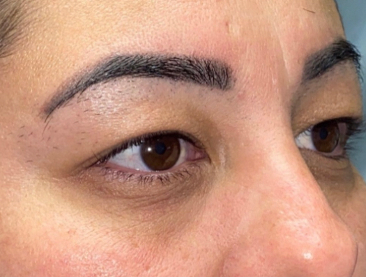 Upper Lid Blepharoplasty (upper eyelid lift)