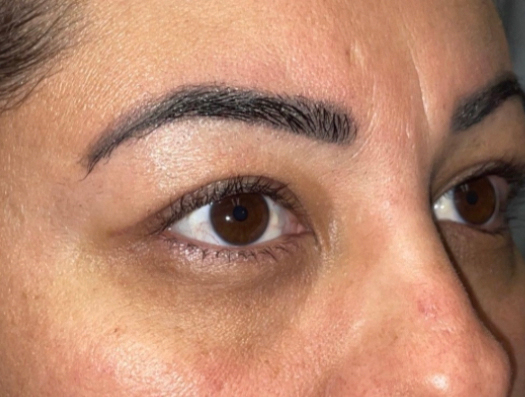 Upper Lid Blepharoplasty (upper eyelid lift)