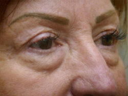 Combination Surgeries (eyelid lift and other)