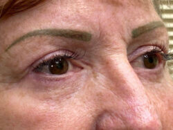 Combination Surgeries (eyelid lift and other)