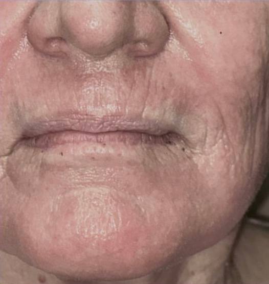 CO2 Laser Resurfacing (wrinkle/line reduction)