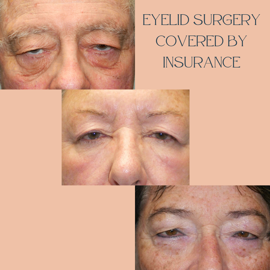 Insurance Pay Eyelid Lift1