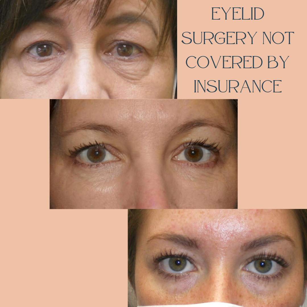 Insurance Pay Eyelid Lift2