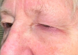 Eyelid Lift (blepharoplasty/ptosis repair)