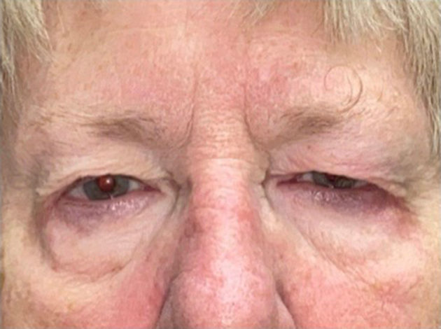 Eyelid Lift (blepharoplasty/ptosis repair)
